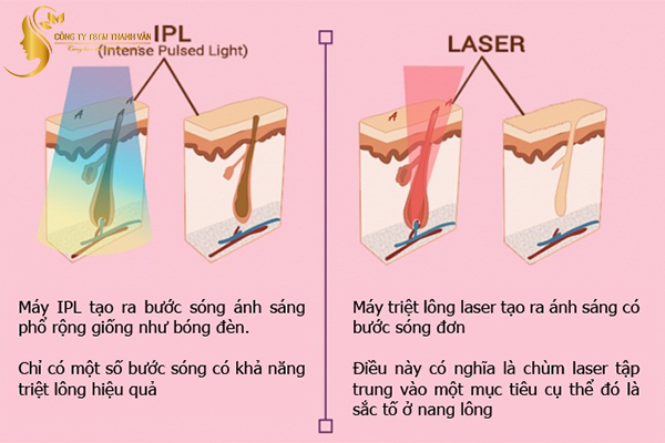 dpl-la-cong-nghe-triet-long-ket-hop-ipl-va-laser
